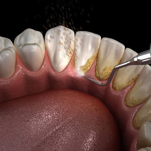 Co je zubní kámen a jak ho odstranit?